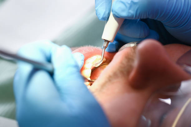 Best Emergency Dental Care for Broken or Chipped Teeth in Mountain Home, AR