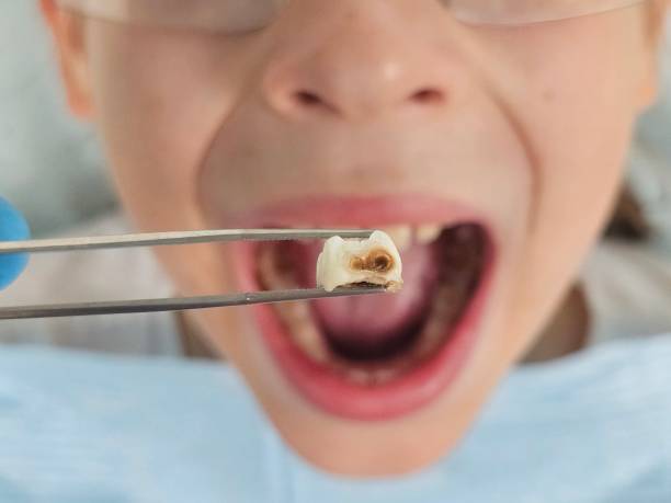 Best Emergency Tooth Extraction in Mountain Home, AR